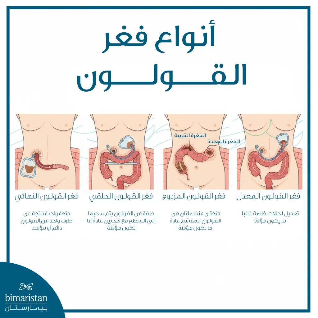 فغر القولون: دليل شامل للعملية والرعاية بعدها 4 توضح الصورة أنواع فغر القولون