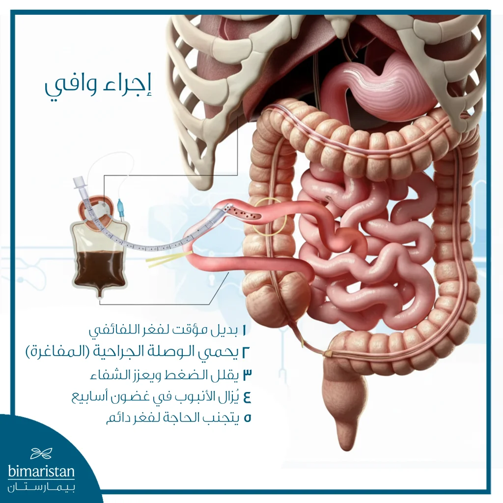 توضح الصورة إجراء وافي الذي يعد بديل لفغر اللفائفي