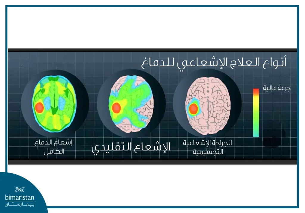 توضح الصورة اختلاف توزيع جرعات الإشعاع بين الأنواع الثلاثة، حيث يركّز العلاج التجسيمي الإشعاع بدقة على الورم فقط.