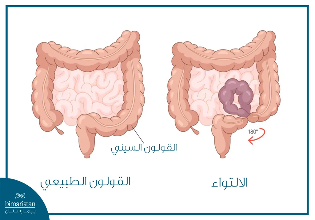 توضح الصورة التواء القولون السيني