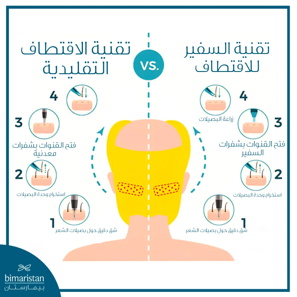 توضح الصورة الفرق بين تقنية Fue التقليدية وتقنية السفير في فتح القنوات وزراعة البصيلات.