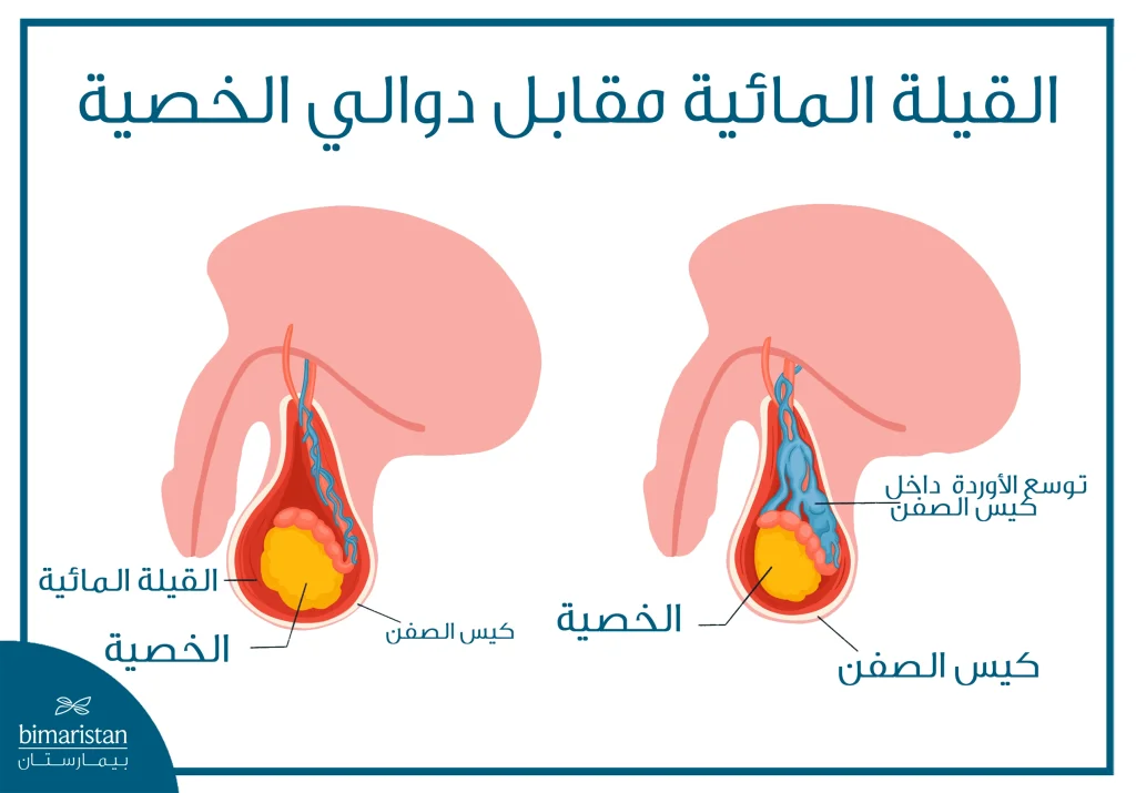 توضح الصورة الفرق بين دوالي الخصية والقيلة المائية حول الخصية