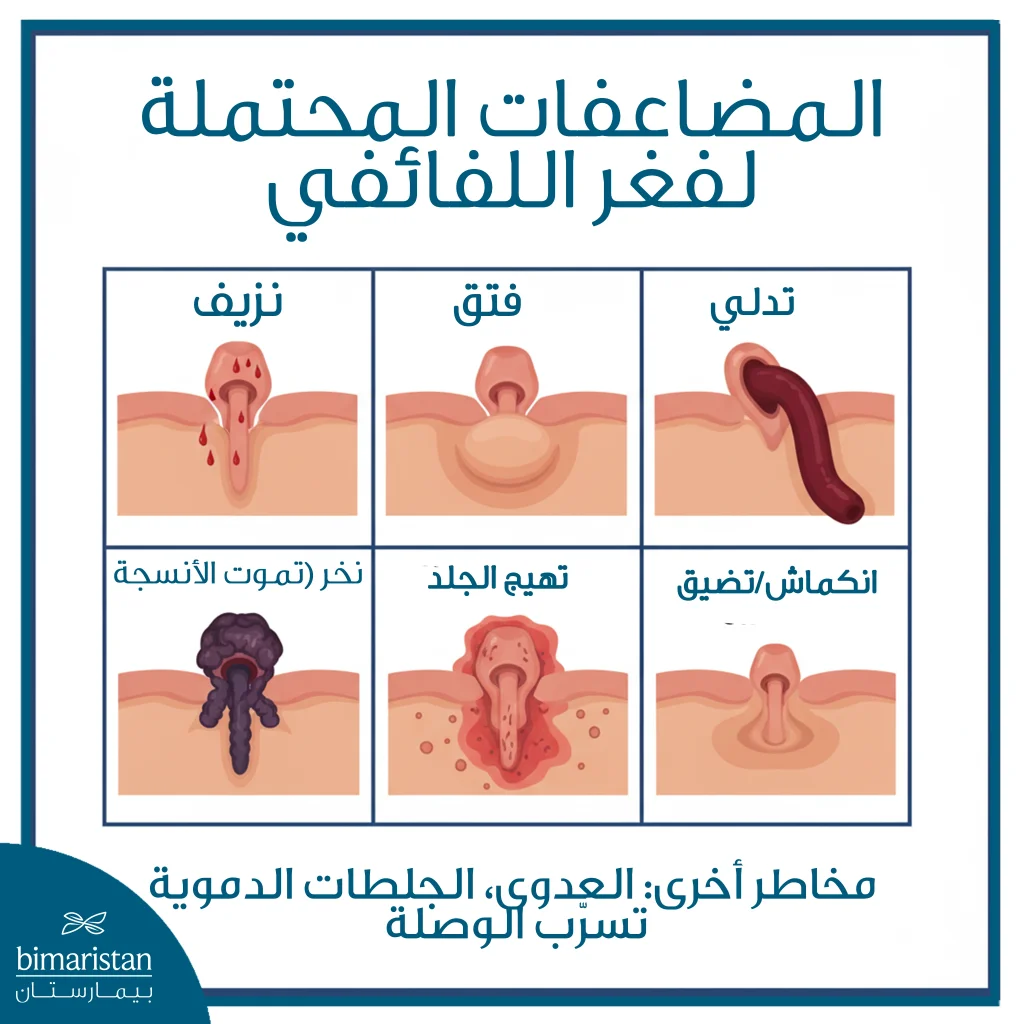 توضح الصورة بعض المضاعفات المحتملة لفغر اللفائفي