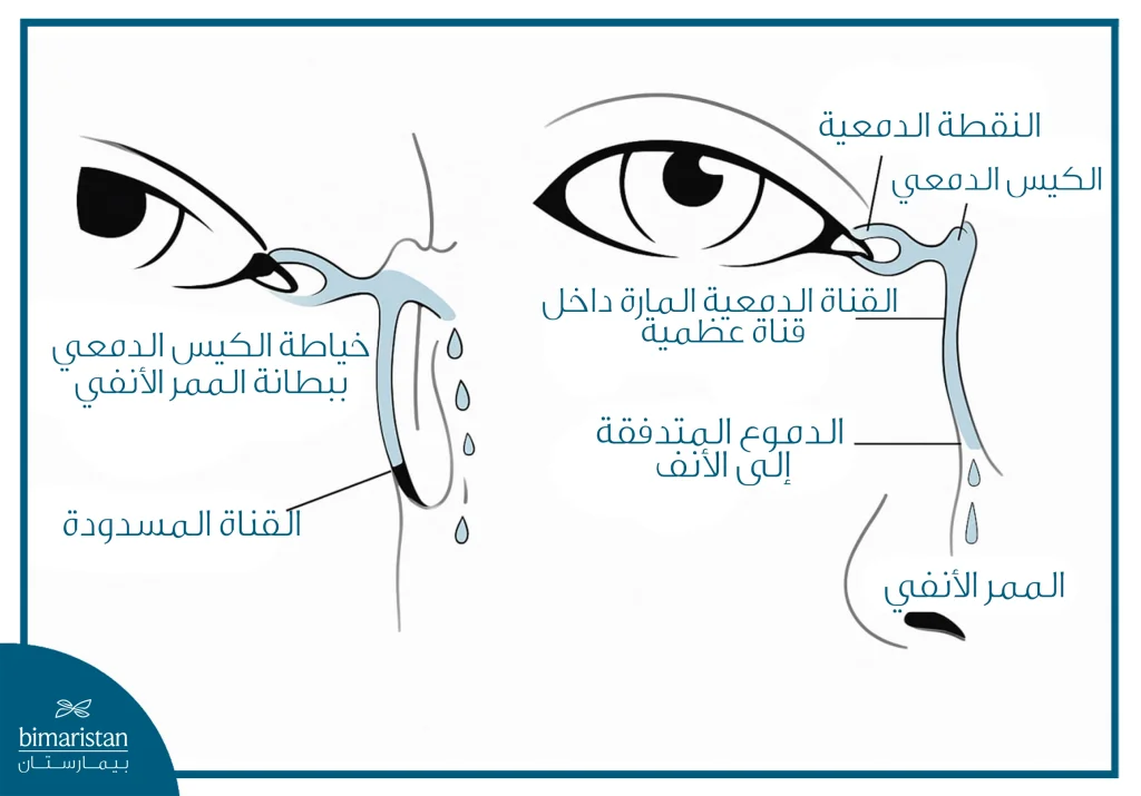 توضح الصورة تدفق الدموع الطبيعي مقابل انسداد مجرى الدمع وكيف تُعاد وصله بالأنف جراحياً لتصريف الدموع.