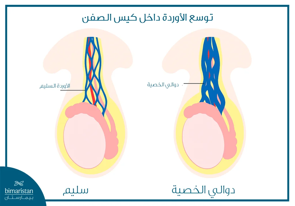 توضح الصورة توسع الأوردة داخل كيس الصفن