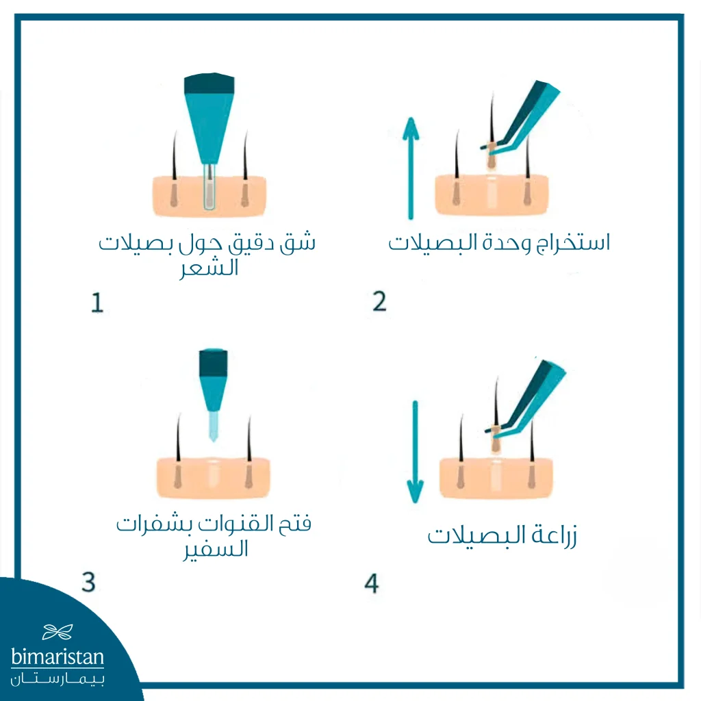 توضح الصورة خطوات زراعة الشعر بتقنية السفير من استخراج البصيلات حتى الزراعة.