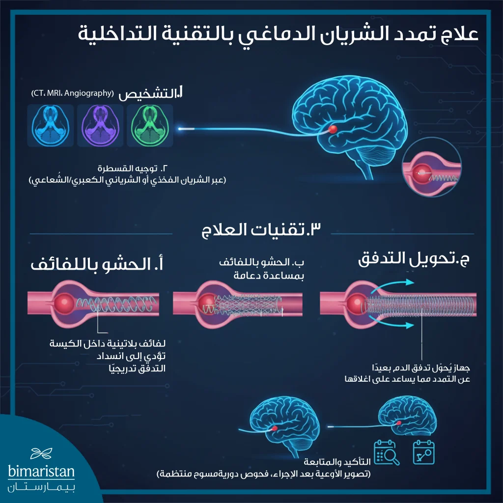 توضح الصورة خطوات علاج تمدد الشريان الدماغي بالتقنية التداخلية