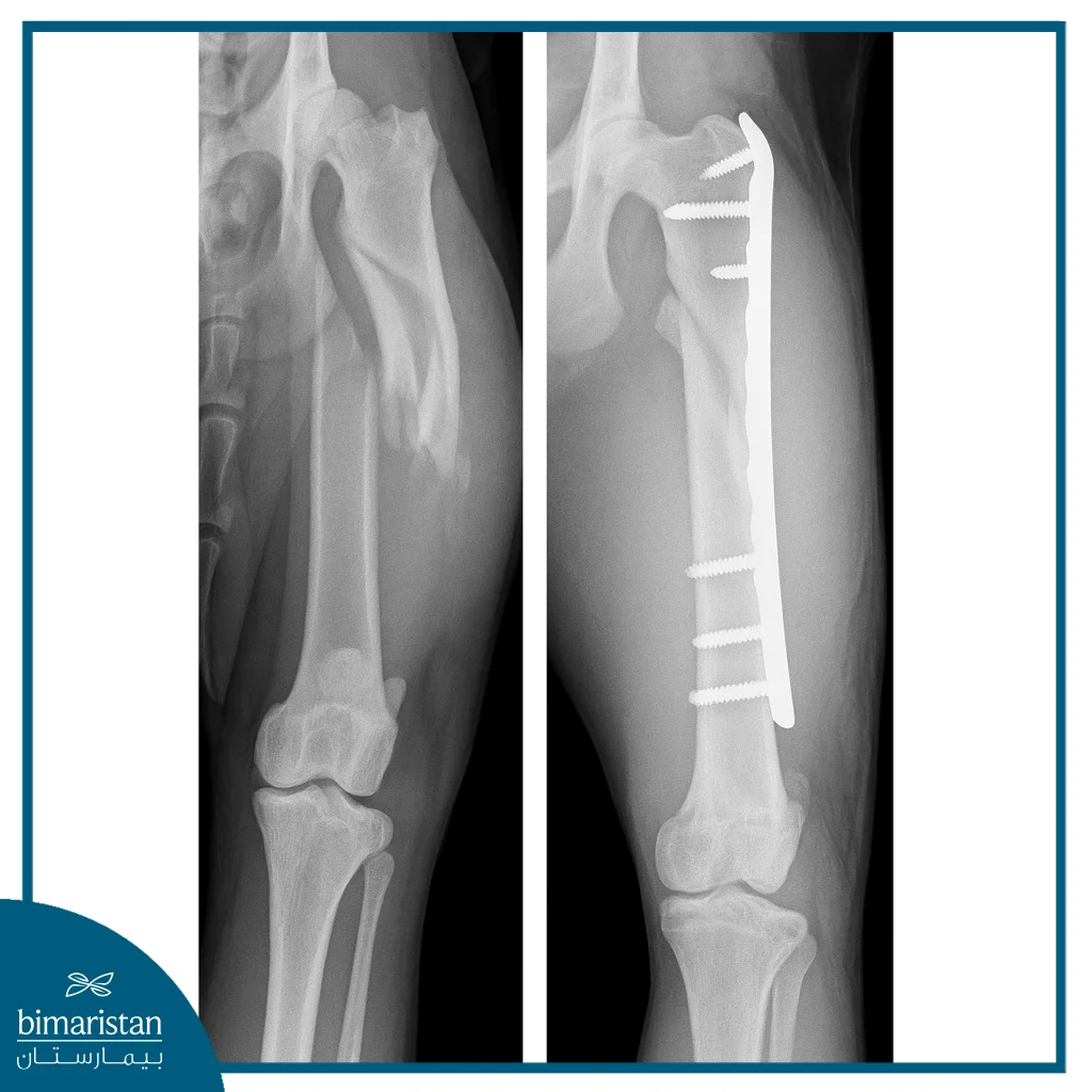 توضح الصورة عملية تثبيت الكسور بالبلاطات الحيوية