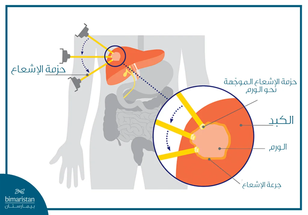 توضح الصورة كيفية توجيه حزم الإشعاع بدقة نحو الورم في الكبد لتدميره مع تقليل التأثير على الأنسجة السليمة.