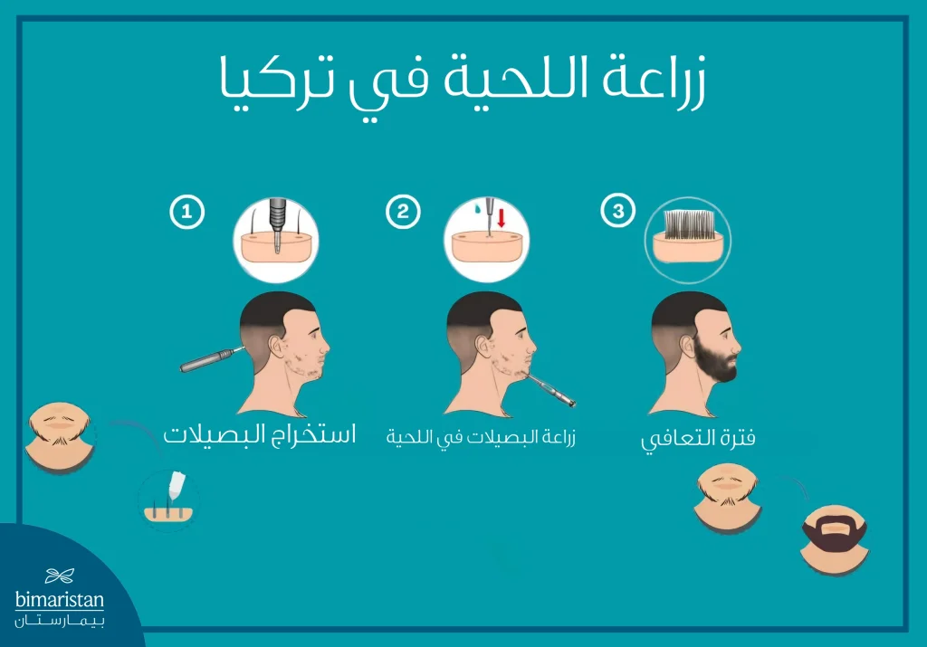 توضح الصورة مراحل زراعة اللحية في تركيا من استخراج البصيلات حتى فترة التعافي النهائية.