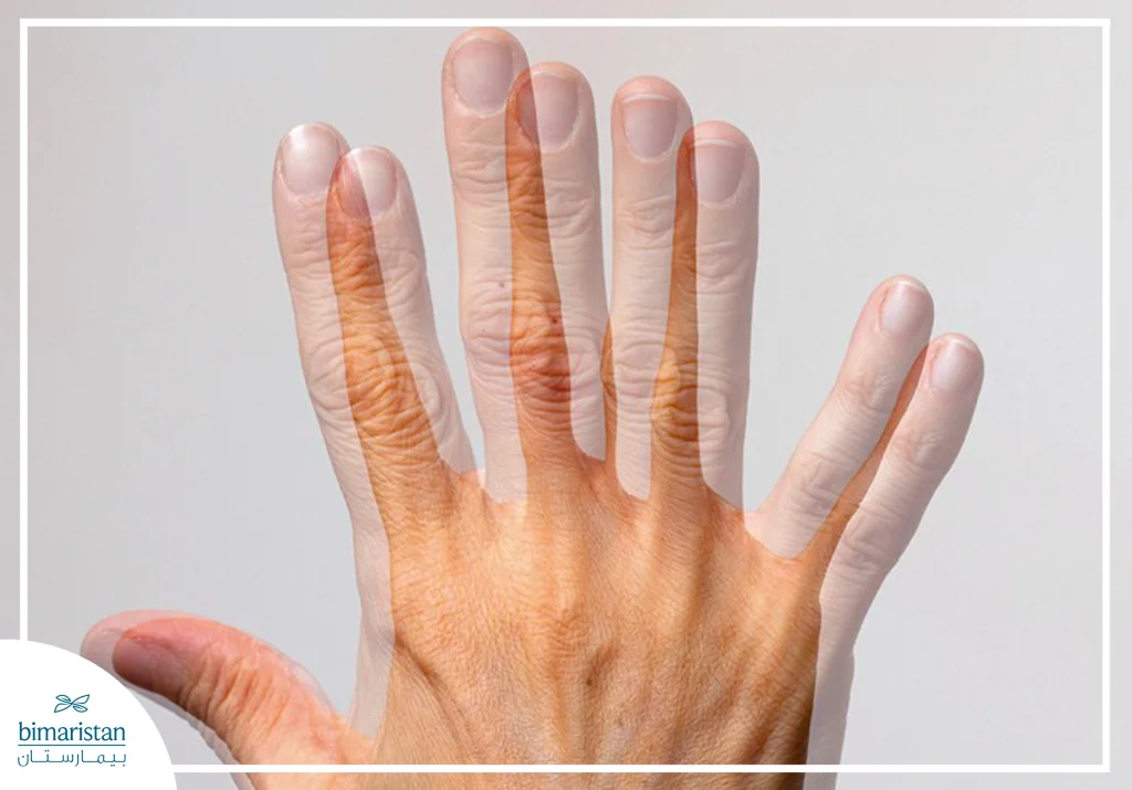 أسباب ازدواجية الرؤية وطرق علاجها الحديثة: دليل شامل للمرضى 3 تُظهر رؤية مزدوجة لليد، حيث يظهر الجسم الواحد على شكل صورتين متداخلتين.