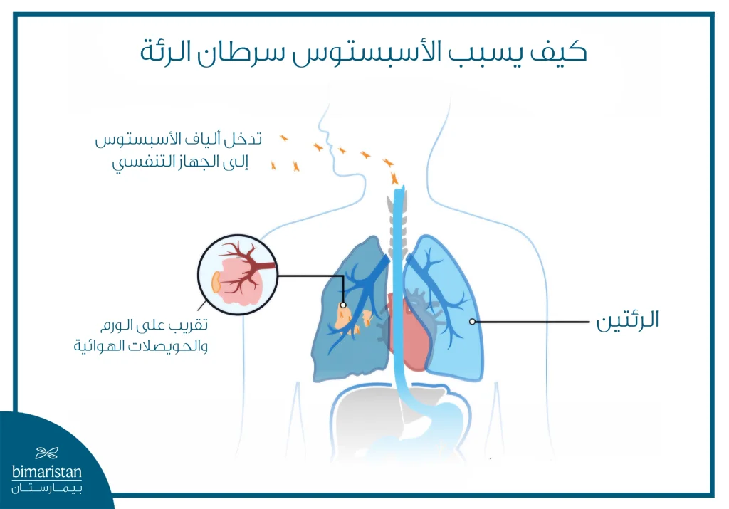 الأسبستوس وسرطان الرئة: كيف يزيد التعرض لهذه المادة خطر الإصابة؟ 4 رسم توضيحي يبين كيف تسبب ألياف الأسبستوس سرطان الرئة عند الاستنشاق
