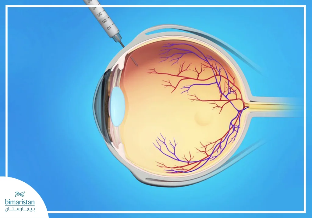 الحقن داخل العين لعلاج أمراض الشبكية: الفعالية وطريقة العلاج 2 الصورة تُظهر مقطعاً تشريحياً للعين مع إبرة تقوم بحقن دواء داخل الجسم الزجاجي. تظهر الشبكية في الجزء الخلفي من العين مع تفرعات الأوعية الدموية باللونين الأحمر والأزرق، بينما يتم توجيه الإبرة بدقة عبر الجزء الأبيض من العين للوصول إلى المساحة الزجاجية دون لمس العدسة أو الشبكية.