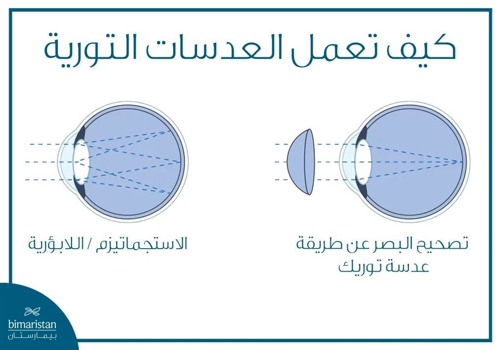 رسم توضيحي يشرح كيفية عمل العدسات التوريك في تصحيح الاستجماتيزم عبر تعديل الانحناء غير المنتظم للقرنية.