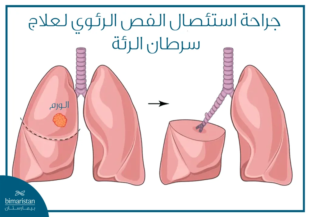 رسم يوضّح جراحة استئصال فص الرئة المصاب بورم في حالة سرطان الرئة الحرشفي