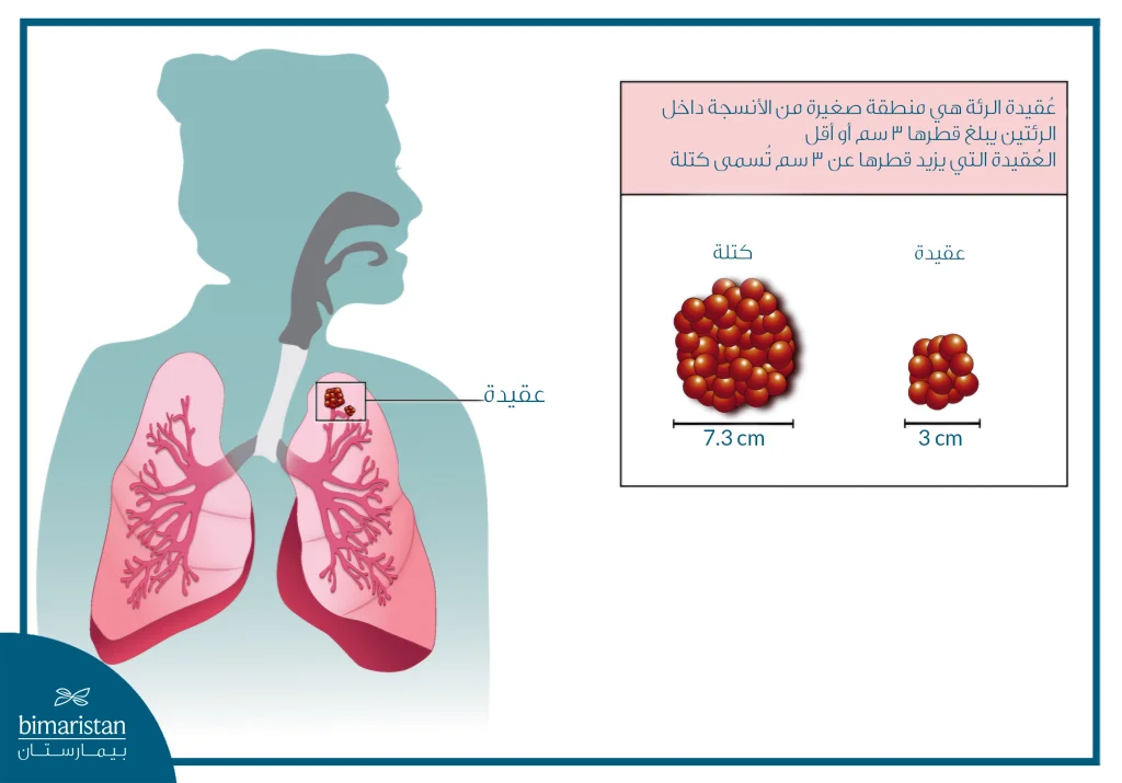 رسم توضيحي يُظهر الفرق بين العقيدات الرئوية والكتلة في الرئة