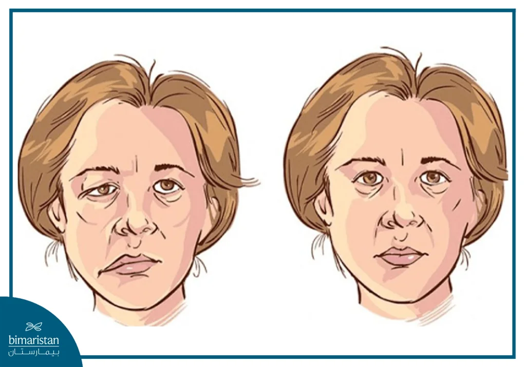 علاج شلل بيل بالليزر: تقنية حديثة لاستعادة حركة الوجه بأمان وفعالية 7 شلل بيل