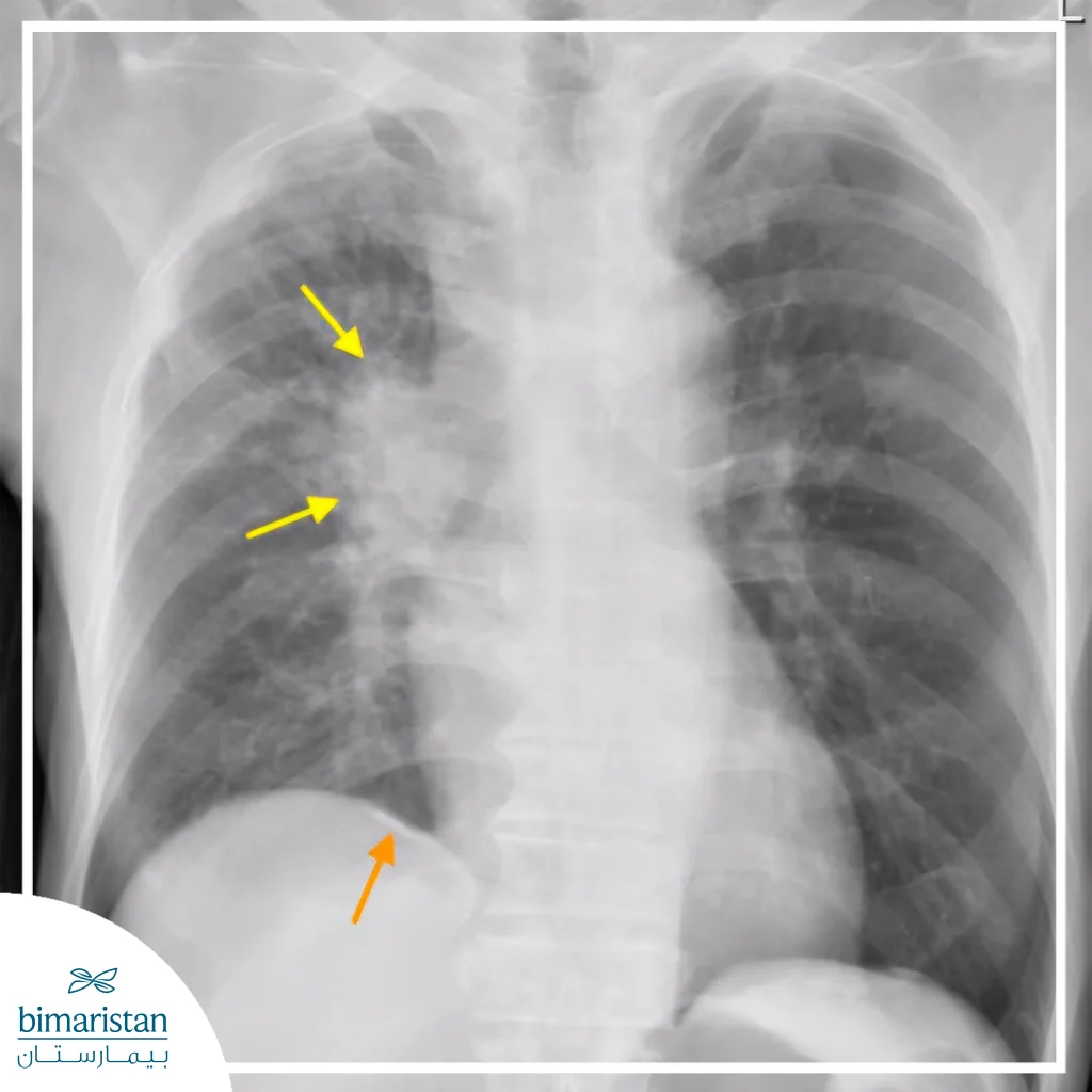 الأسبستوس وسرطان الرئة: كيف يزيد التعرض لهذه المادة خطر الإصابة؟ 5 صورة أشعة صدر تُظهر كتلة رئوية ولويحات جنبية ناتجة عن الأسبستوس