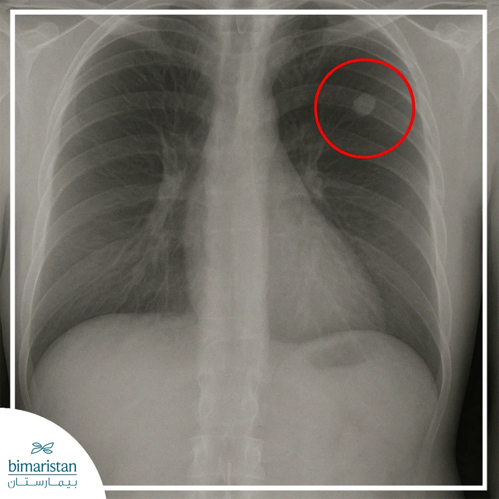 صورة أشعة للصدر تُظهر عقيدة رئوية مفردة