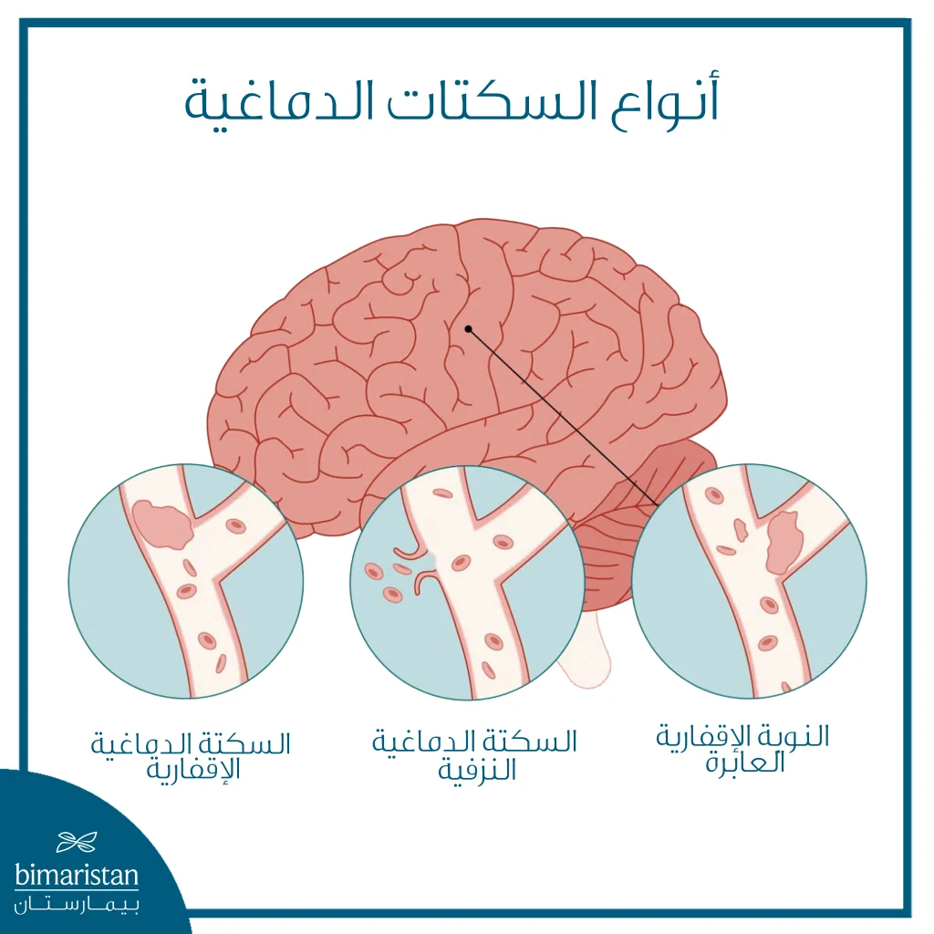 كيفية الوقاية من السكتة الدماغية: دليل مبسط للحفاظ على صحة الدماغ والأوعية 6 صورة تظهر الفرق بين أنواع السكتة الدماغية