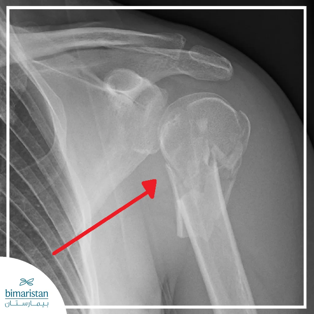 صورة تظهر كسراً واضحاً في عظم العضد