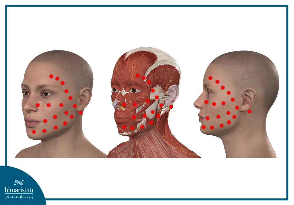 علاج شلل بيل بالليزر: تقنية حديثة لاستعادة حركة الوجه بأمان وفعالية 8 صورة تظهر مسار الليزر على العصب الوجهي