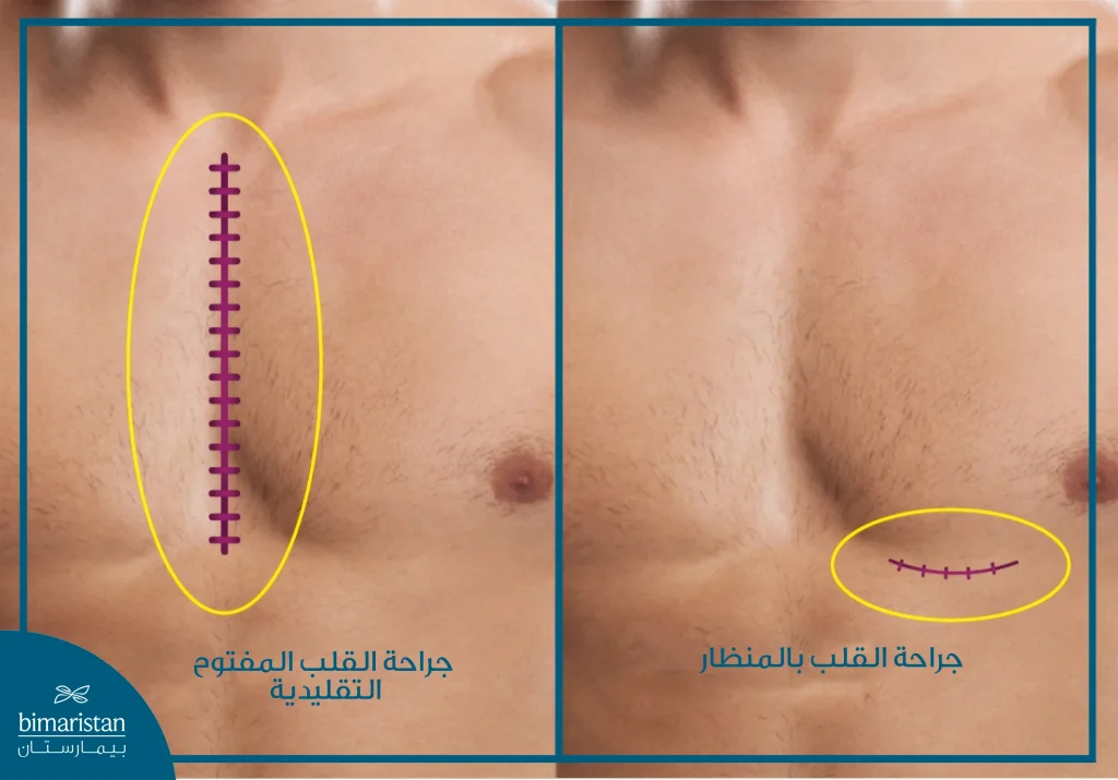 صورة توضح الفرق بين ندبة جراحة القلب المفتوح وندبة جراحة القلب بالمنظار