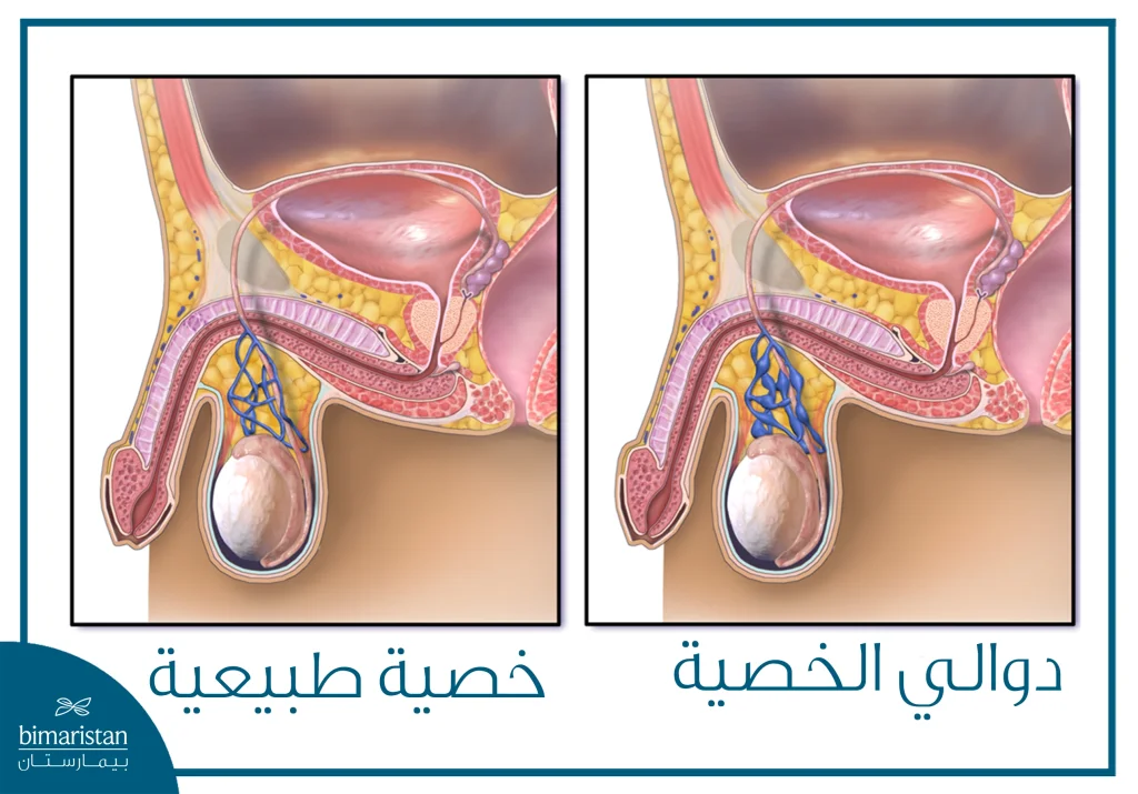صورة توضح الفرق ما بين الخصية الطبيعية ودوالي الخصية
