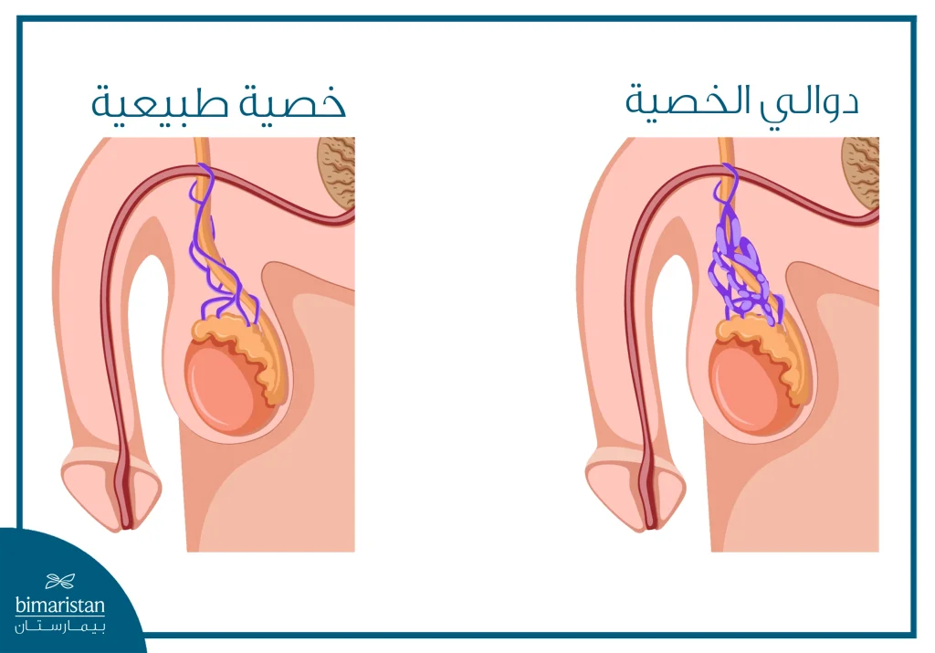 صورة توضح الفرق ما بين الخصية الطبيعية ودوالي الخصية