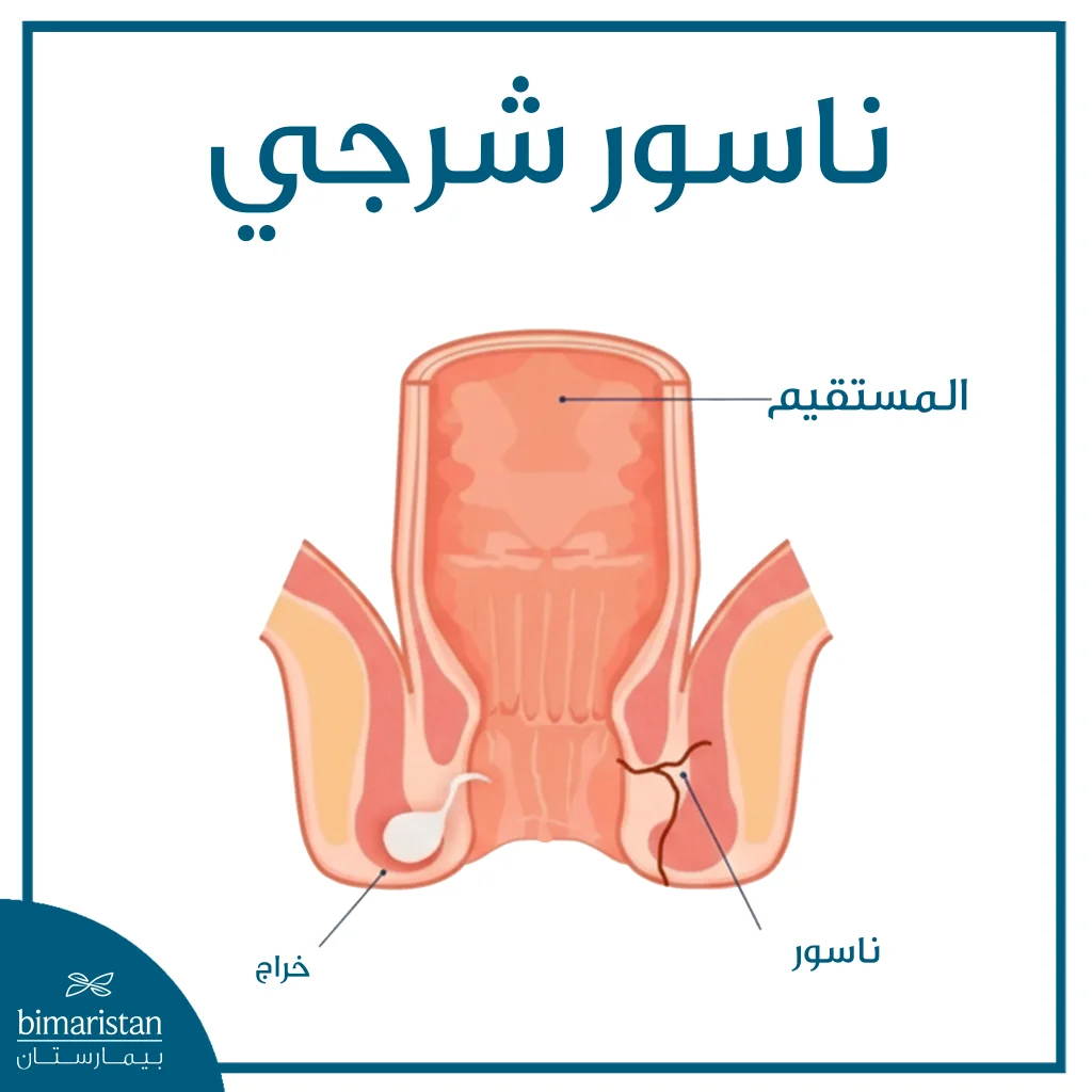 صورة توضح الناسور الشرجي