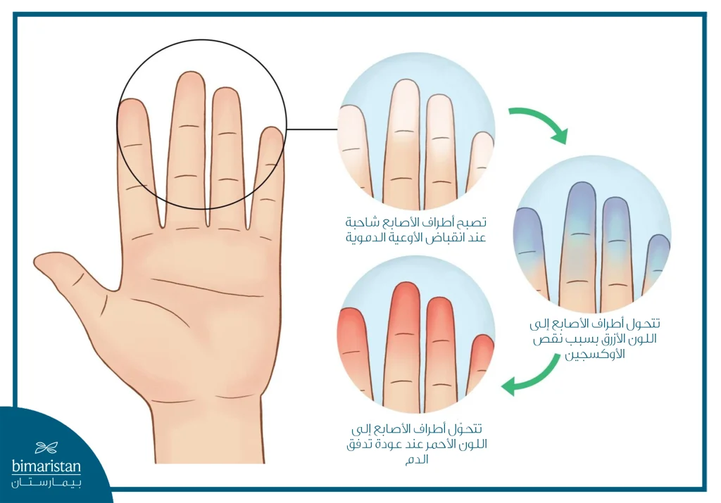 صورة توضح تغيّر ألوان الأصابع الثلاثي في مرض رينود