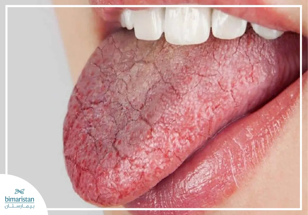 صورة توضح جفاف الفم الشديد