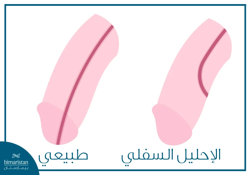 صورة توضح حالة الإحليل السفلي التي تتطلب جراحة المسالك البولية للأطفال