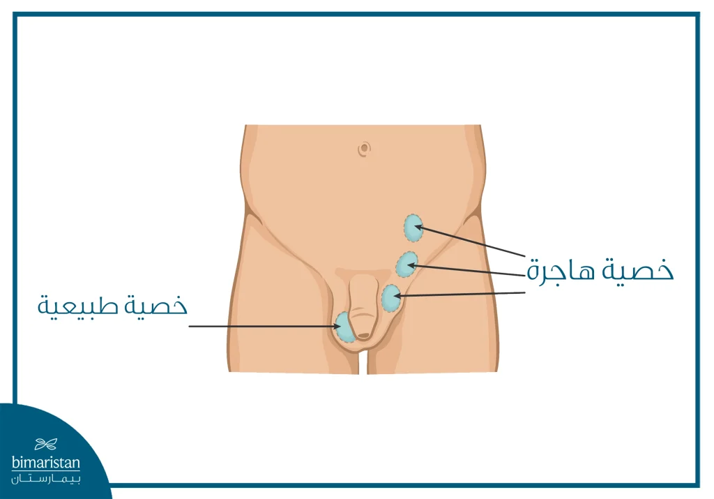صورة توضح حالة الخصية الهاجرة التي تتطلب جراحة المسالك البولية للأطفال