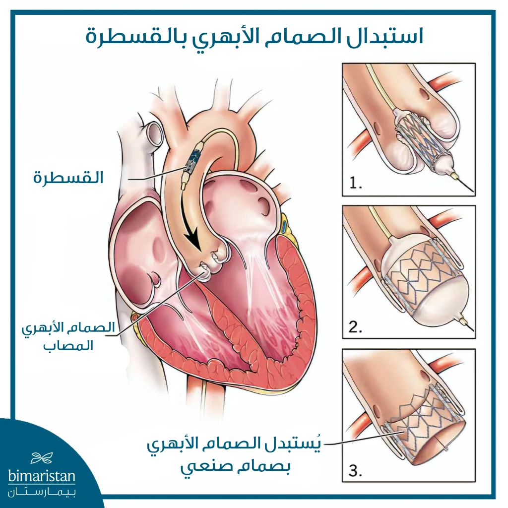 صورة توضح خطوات استبدال الصمام الأبهري عبر القسطرة