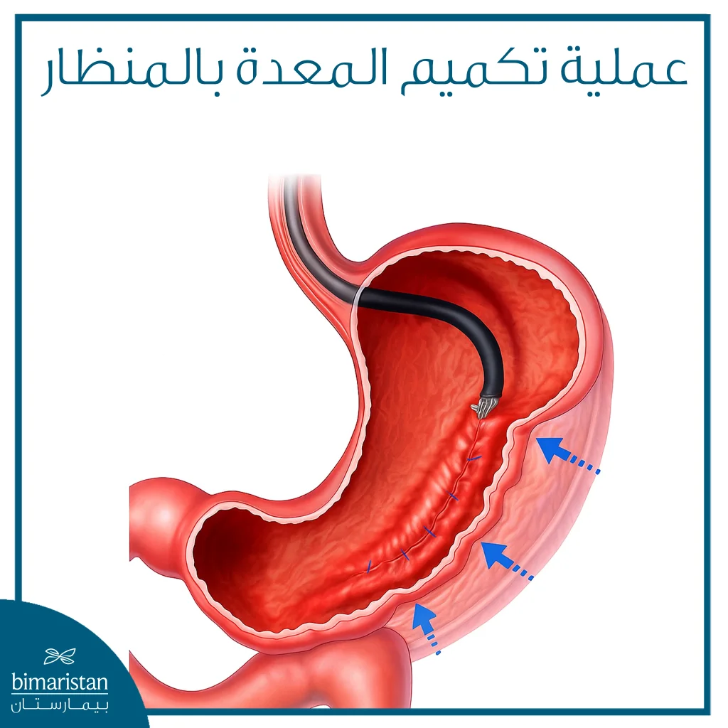 صورة توضح عملية تكميم المعدة بالمنظار