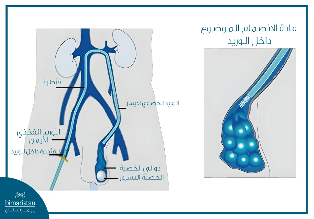صورة توضح عميلة إجراء علاج دوالي الخصية بالقسطرة