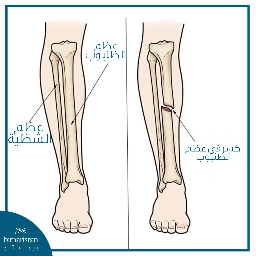 كسر الساق كيفية تحديد نوعه وطرق علاجه 13 صورة توضح كسر الظنبوب