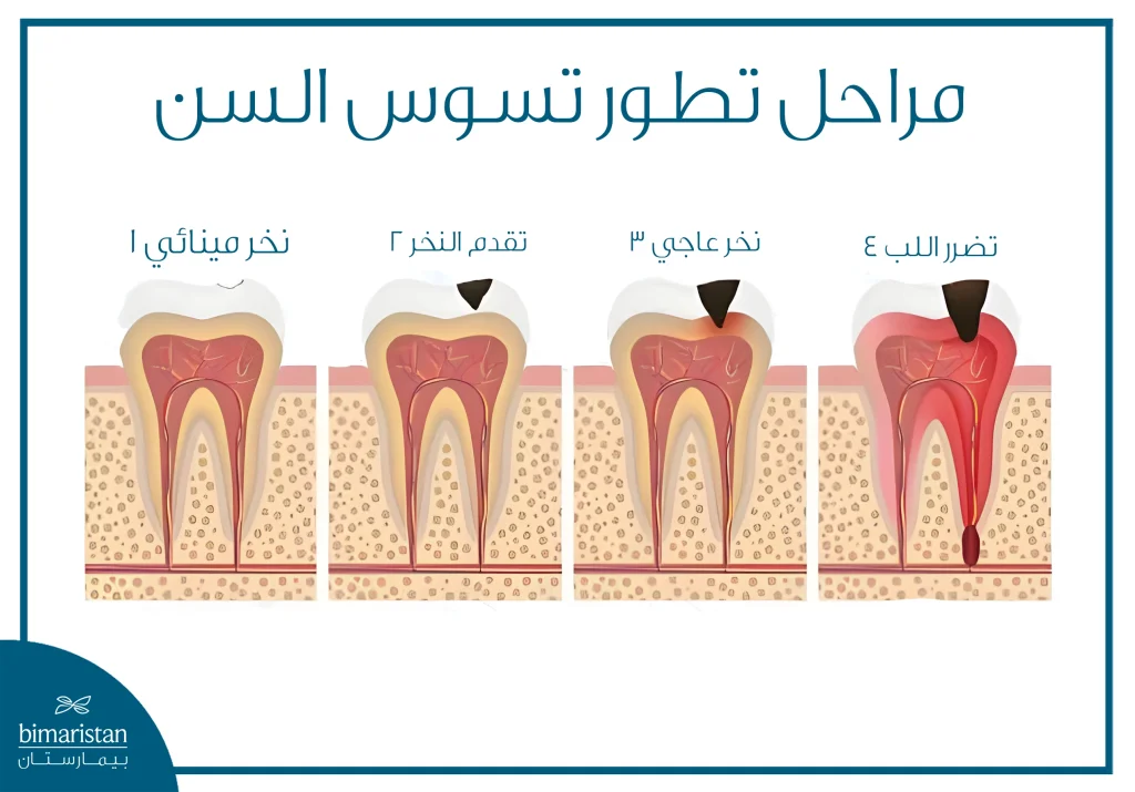 صورة توضح مراحل تطور تسوس السن