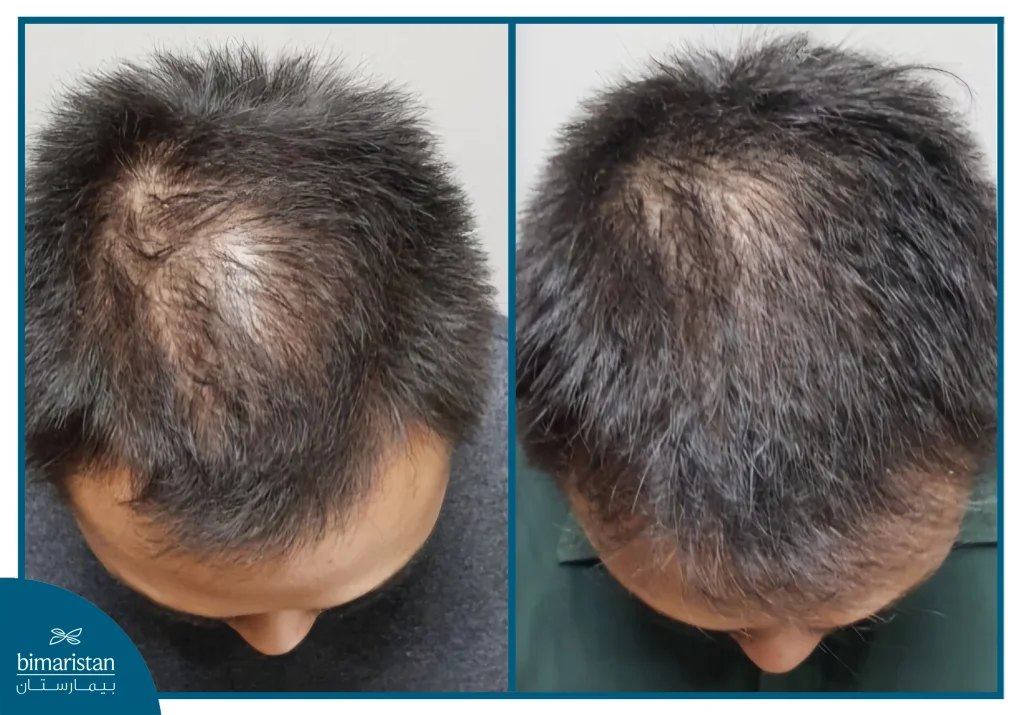 صورة قبل وبعد تُظهر تحسن كثافة الشعر بعد علاج الريجينيرا.
