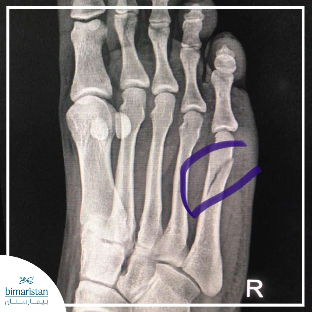 صورة بالأشعة السينية تظهر كسراً واضحاً في مشط القدم