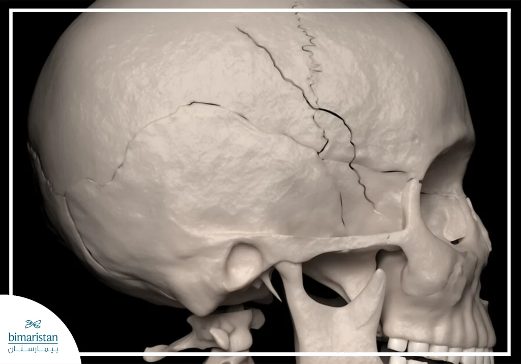 Everything You Need To Know About Skull Fracture
