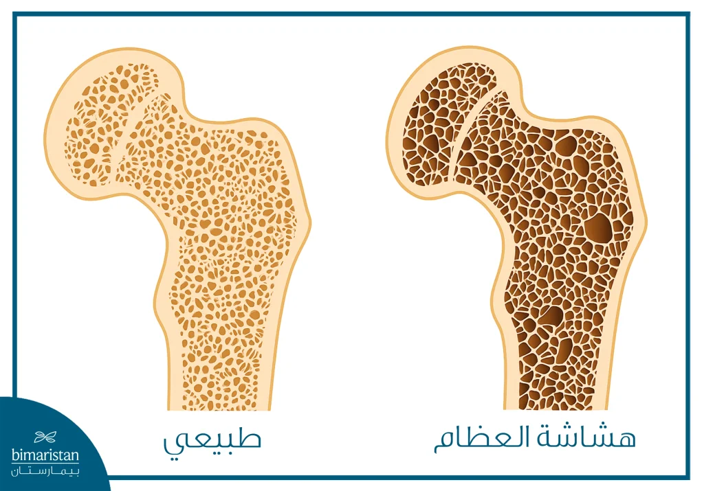 هشاشة العظام من أهم أسباب اللجوء لجراحة