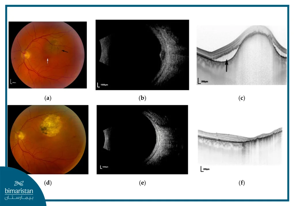 A Set Of Retinal Imaging Scans Of A Patient With A Choroidal Tumor, Including Color Fundus Photographs (A, D), B-Scan Ultrasonography Images (B, E), And Oct Cross-Sectional Scans (C, F) Showing Retinal Elevation Over The Tumor Before And After Treatment.