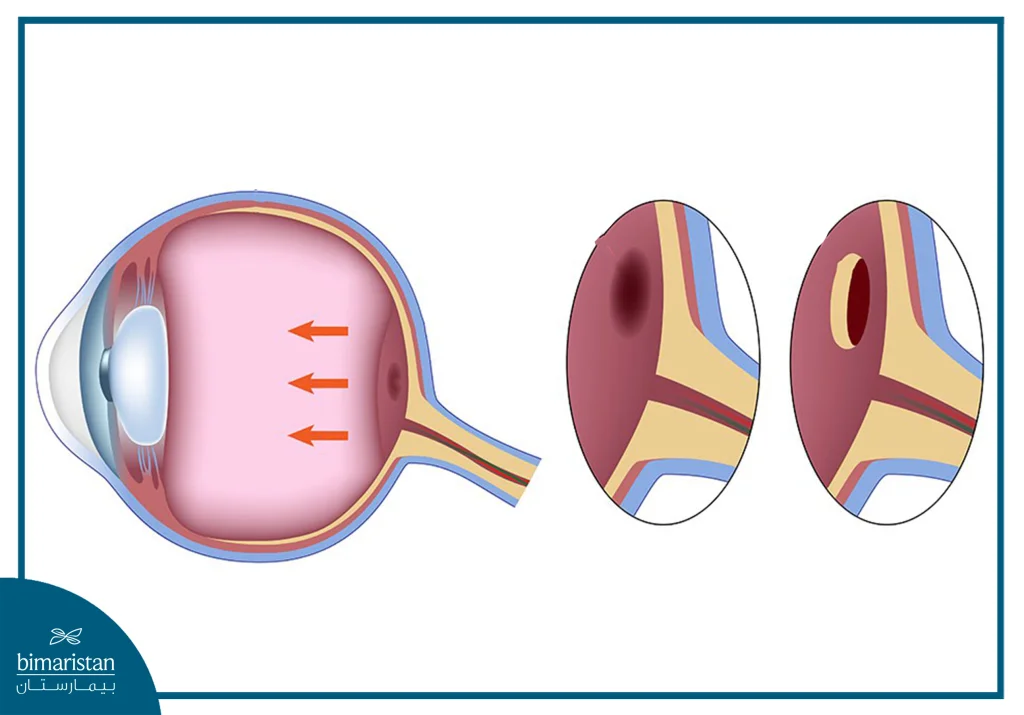 توضح الصورة موقع البقعة الصفراء في مركز الشبكية وكيف يؤدي شدّ الجسم الزجاجي إلى تكوّن ثقب فيها. يُقارن الرسم بين البقعة السليمة والبقعة المصابة بثقب واضح في نسيجها المركزي.
