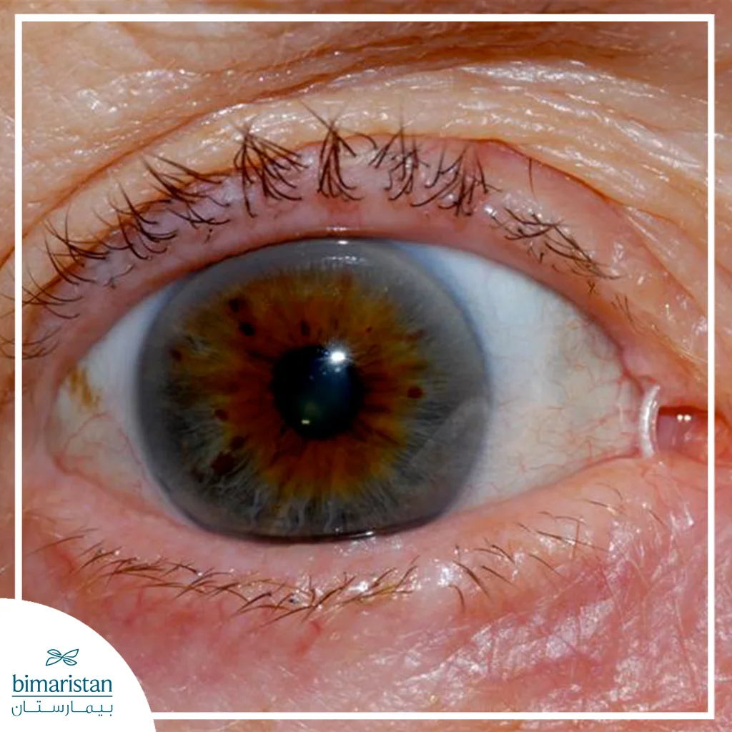 تُظهر الصورة عين مريض بعد عملية انسداد مجرى الدمع، ويُلاحظ أنبوب السيليكون الرفيع المثبّت في الزاوية الداخلية للجفن لتصريف الدموع بشكل مؤقت حتى التئام المجرى الجديد.