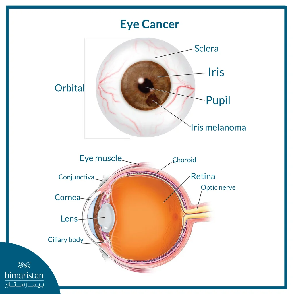 An Anatomical Illustration Showing The Structure Of The Eye And Locations Where Eye Cancer Can Develop, Including An Iris Melanoma. The Diagram Labels Major Eye Parts Such As The Sclera, Iris, Pupil, Retina, Choroid, And Optic Nerve.