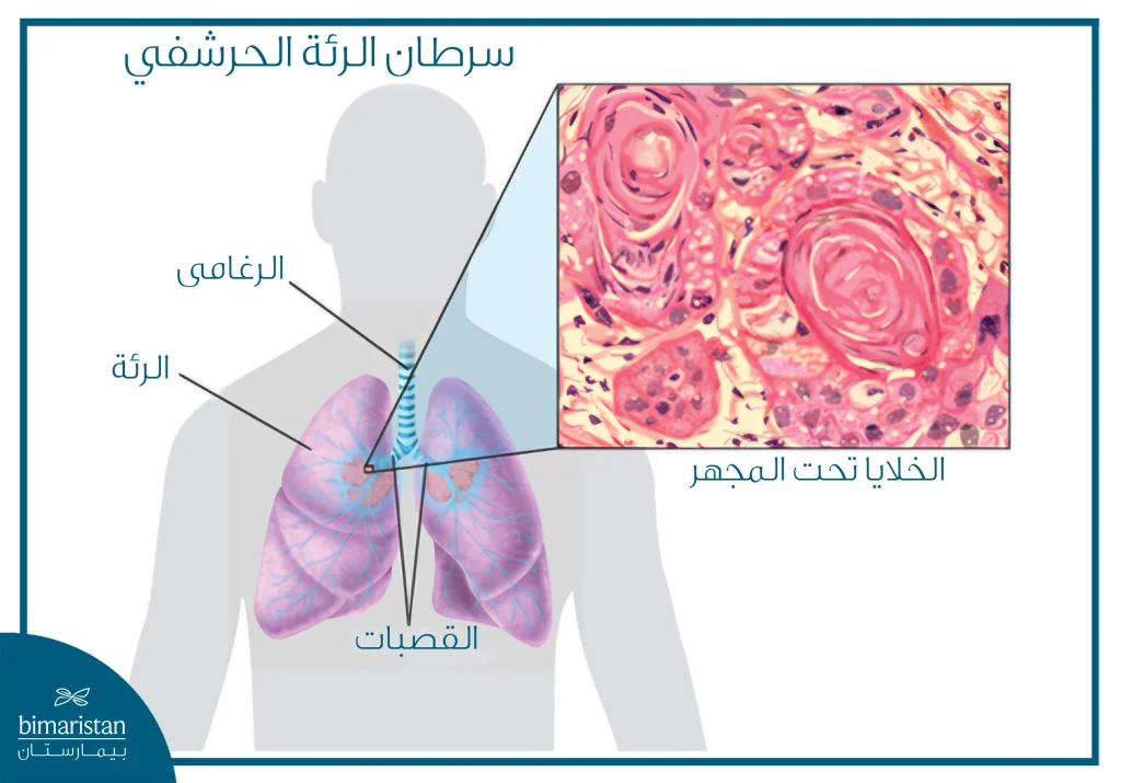 رسم توضيحي يبيّن موقع سرطان الرئة الحرشفي داخل الرئة مع صورة مجهرية للخلايا المصابة