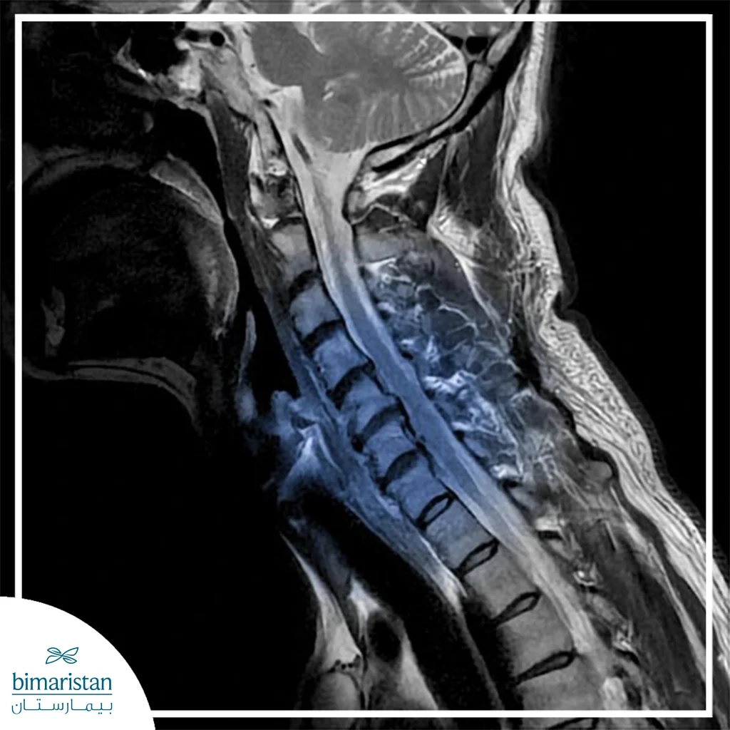 An Mri Showing A Herniated Disc Pressing On The Spinal Cord
