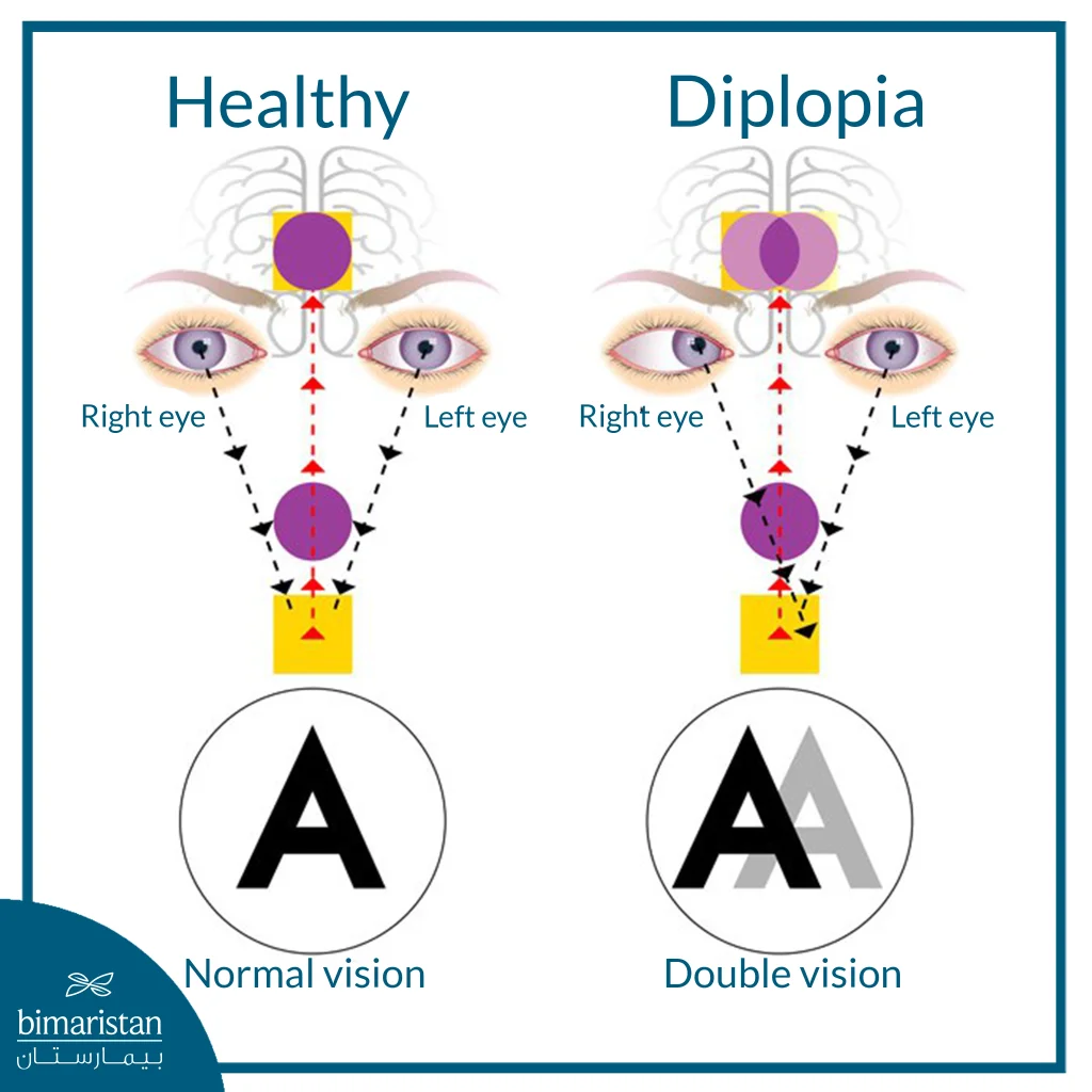 A Diagram Explaining The Difference Between Normal Vision And Diplopia, Demonstrating How Misalignment Of The Eyes Causes The Brain To Receive Two Different Images.